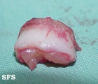cirsoid aneurysm