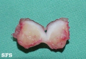 cirsoid aneurysm
