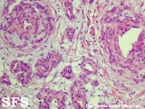 cirsoid aneurysm