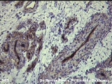 cirsoid aneurysm
