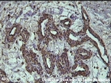 cirsoid aneurysm