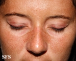 dermatomyositis
