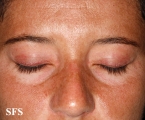 dermatomyositis
