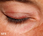 dermatomyositis