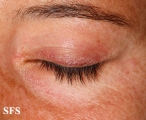 dermatomyositis