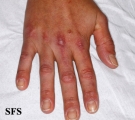 dermatomyositis