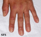 dermatomyositis