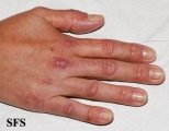 dermatomyositis