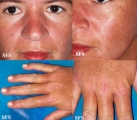 dermatomyositis