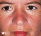 dermatomyositis