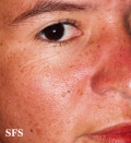 dermatomyositis