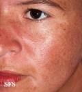 dermatomyositis