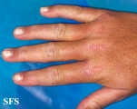 dermatomyositis