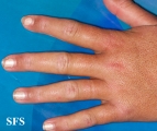 dermatomyositis