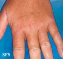 dermatomyositis