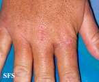 dermatomyositis