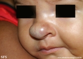 haemangioma