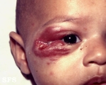 haemangioma
