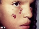 haemangioma