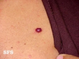 haemangioma