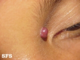 haemangioma