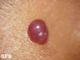 haemangioma