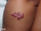 haemangioma