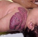 haemangioma