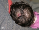haemangioma