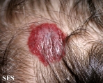 haemangioma
