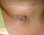 haemangioma