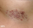 haemangioma