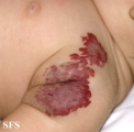 haemangioma