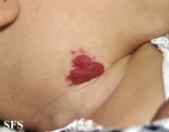 haemangioma