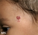 haemangioma