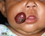 haemangioma
