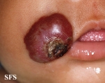 haemangioma