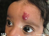 haemangioma