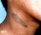 dermatosis cenicienta