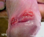 chancroid