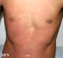 toxoplasmose