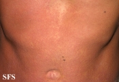 toxoplasmose
