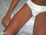 toxoplasmose