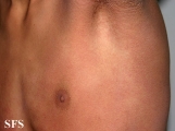 toxoplasmose