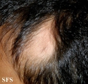 alopecia triangularis congenita