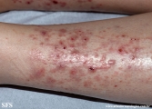 pretibial_dominant_dystrophic_epidermolysis_bullosa