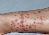 pretibial_dominant_dystrophic_epidermolysis_bullosa