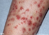 pretibial_dominant_dystrophic_epidermolysis_bullosa