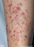pretibial_dominant_dystrophic_epidermolysis_bullosa