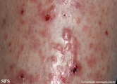 pretibial_dominant_dystrophic_epidermolysis_bullosa